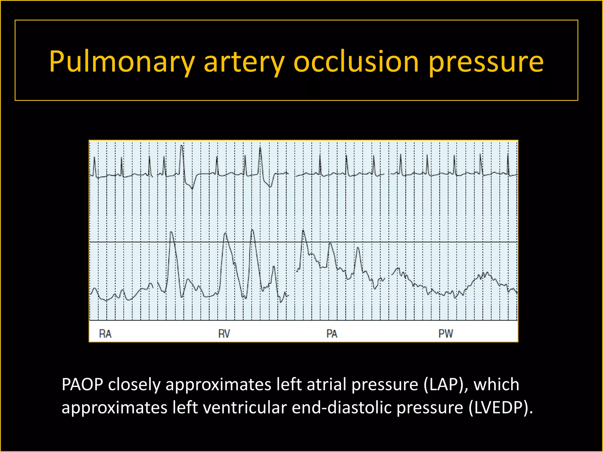 Pulmonary artery occlusion pressure

PAOP closely approximates left atrial pressure (LAP), which
approximates left ventricular end-diastolic pressure (LVEDP).

 