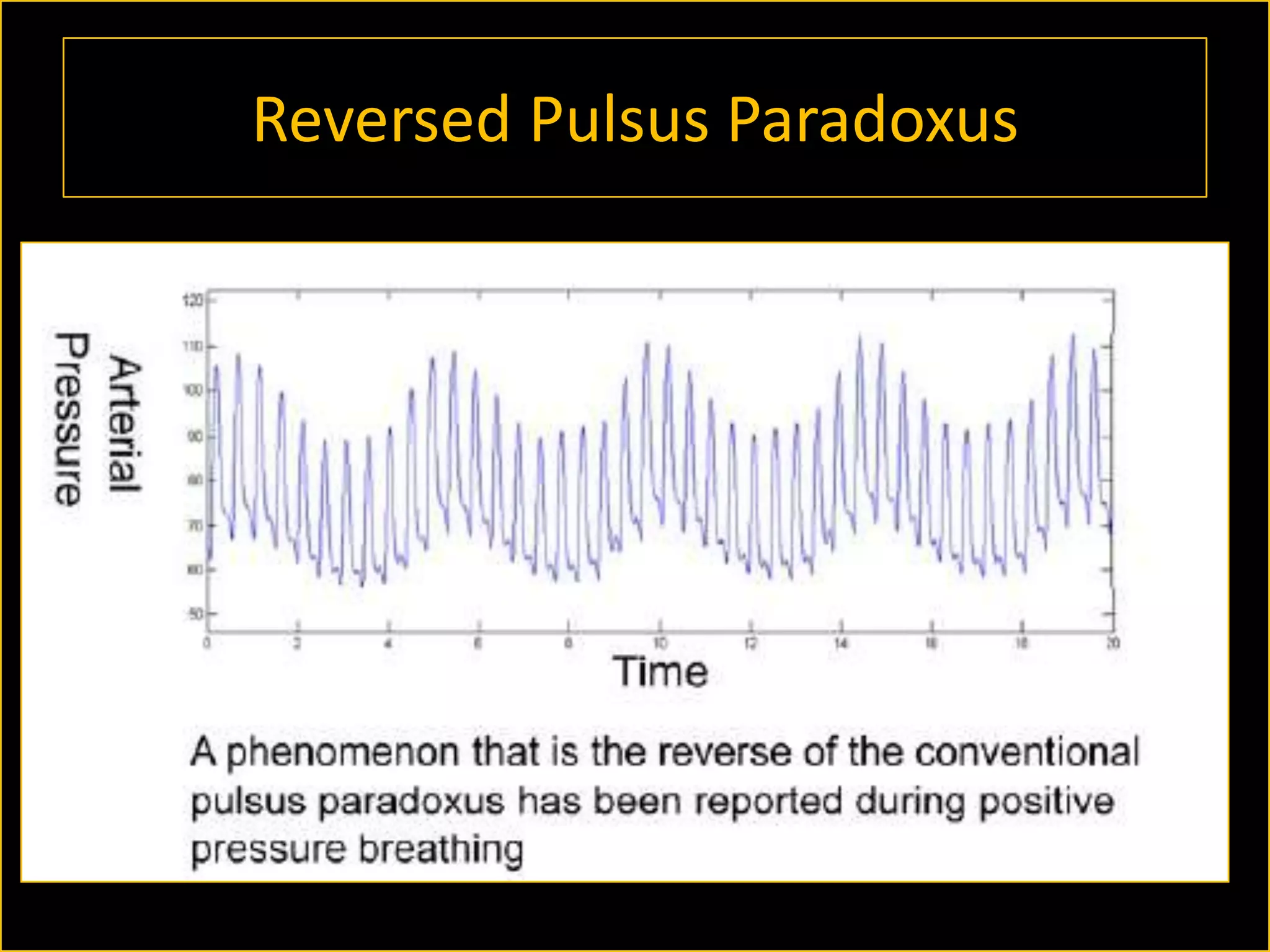 Reversed Pulsus Paradoxus

 