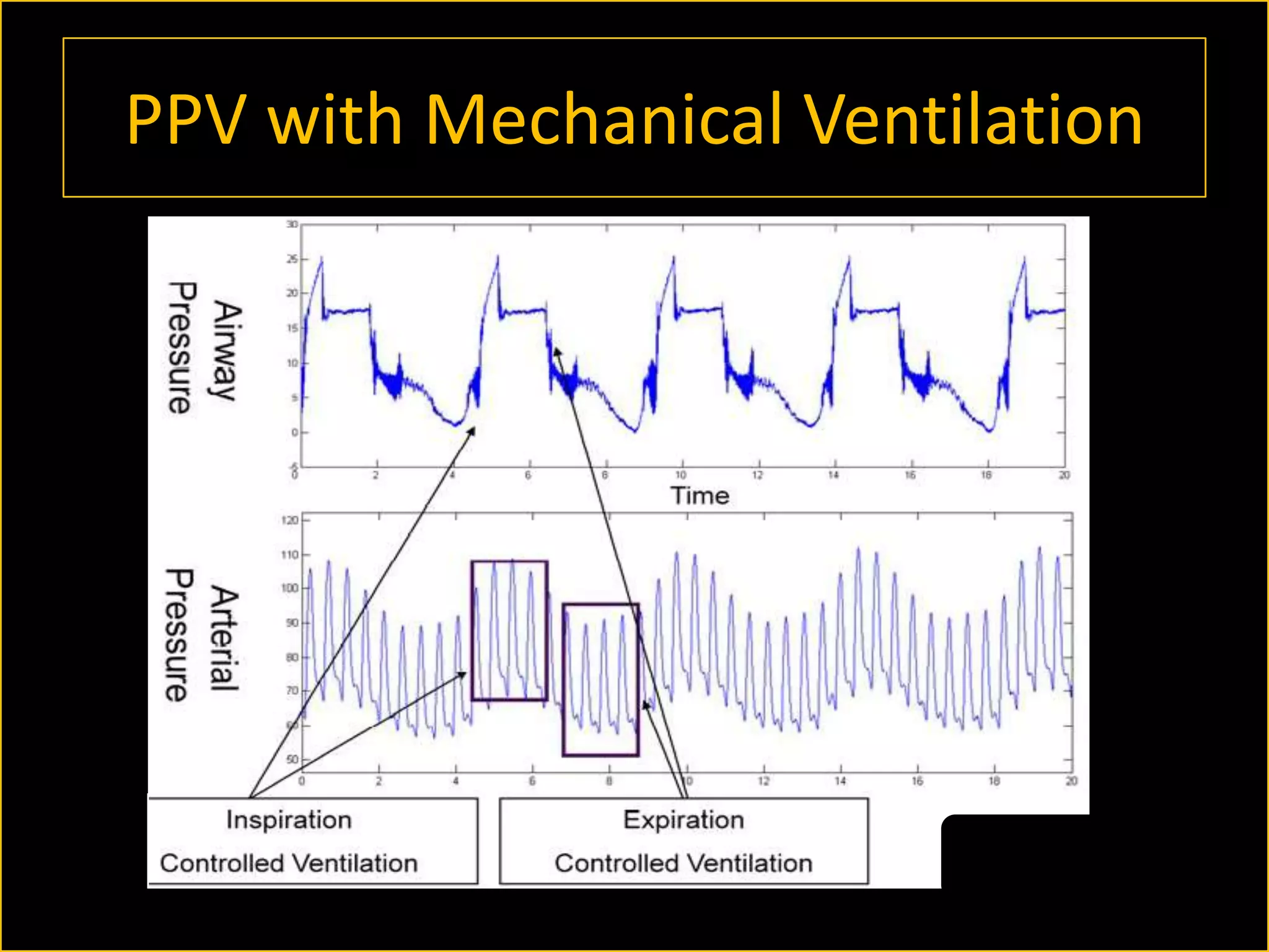 PPV with Mechanical Ventilation

 