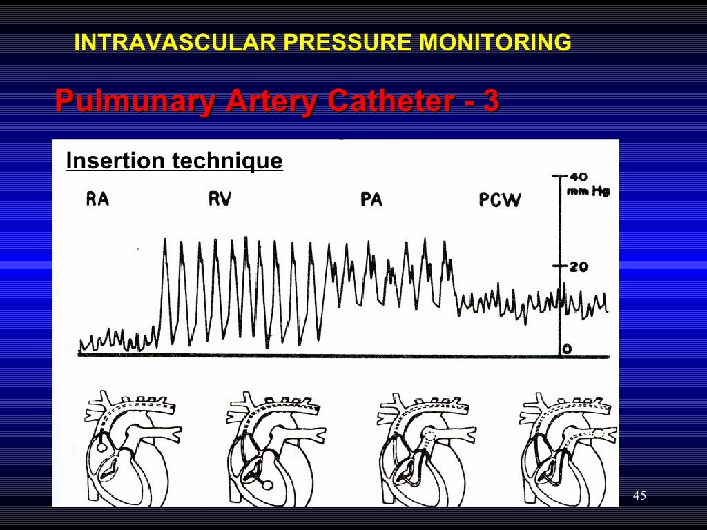 Hemodynamic Pressure Monitoring