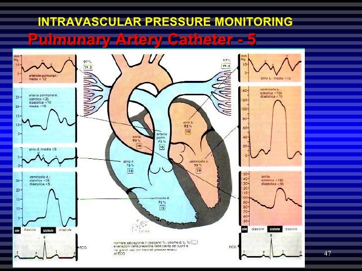 pulmonary-wedge-pressure-wikiwand