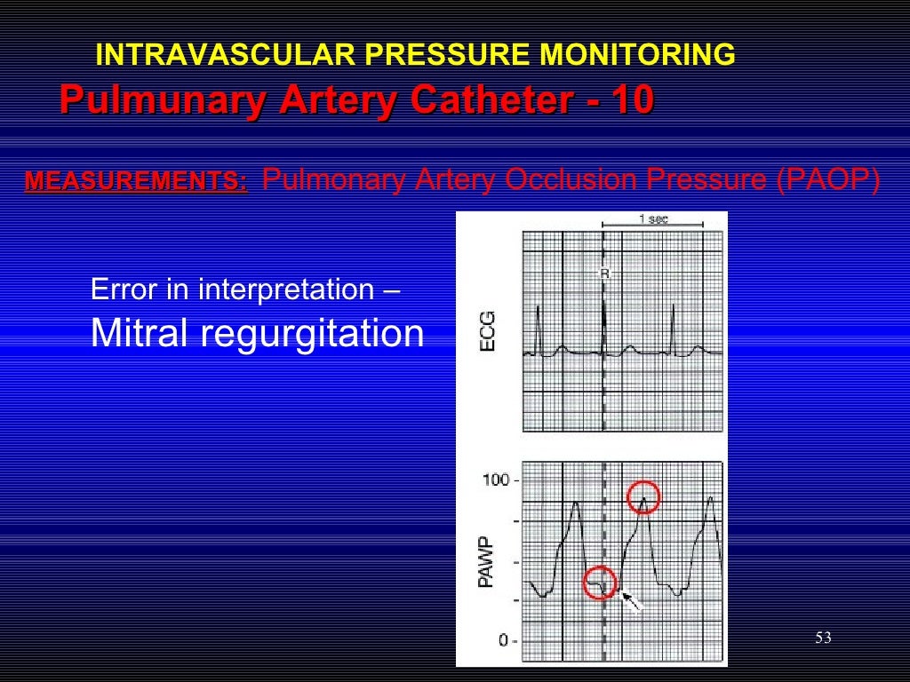 Hemodynamic Pressure Monitoring