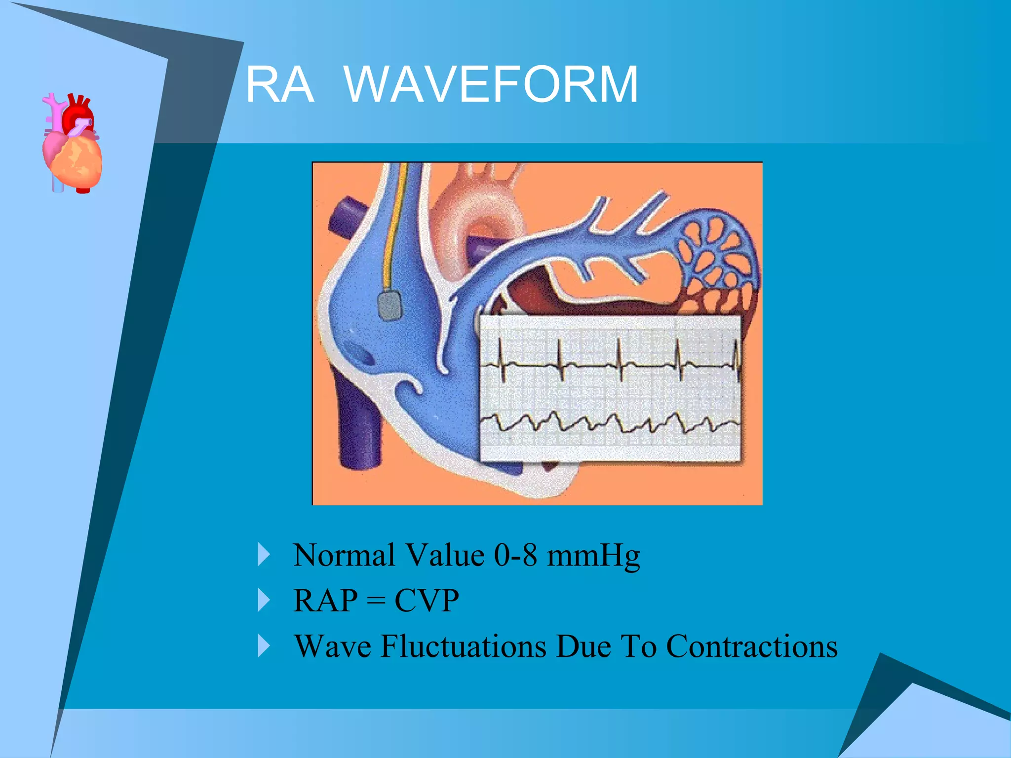 RA  WAVEFORM Normal Value 0-8 mmHg RAP = CVP Wave Fluctuations Due To Contractions 