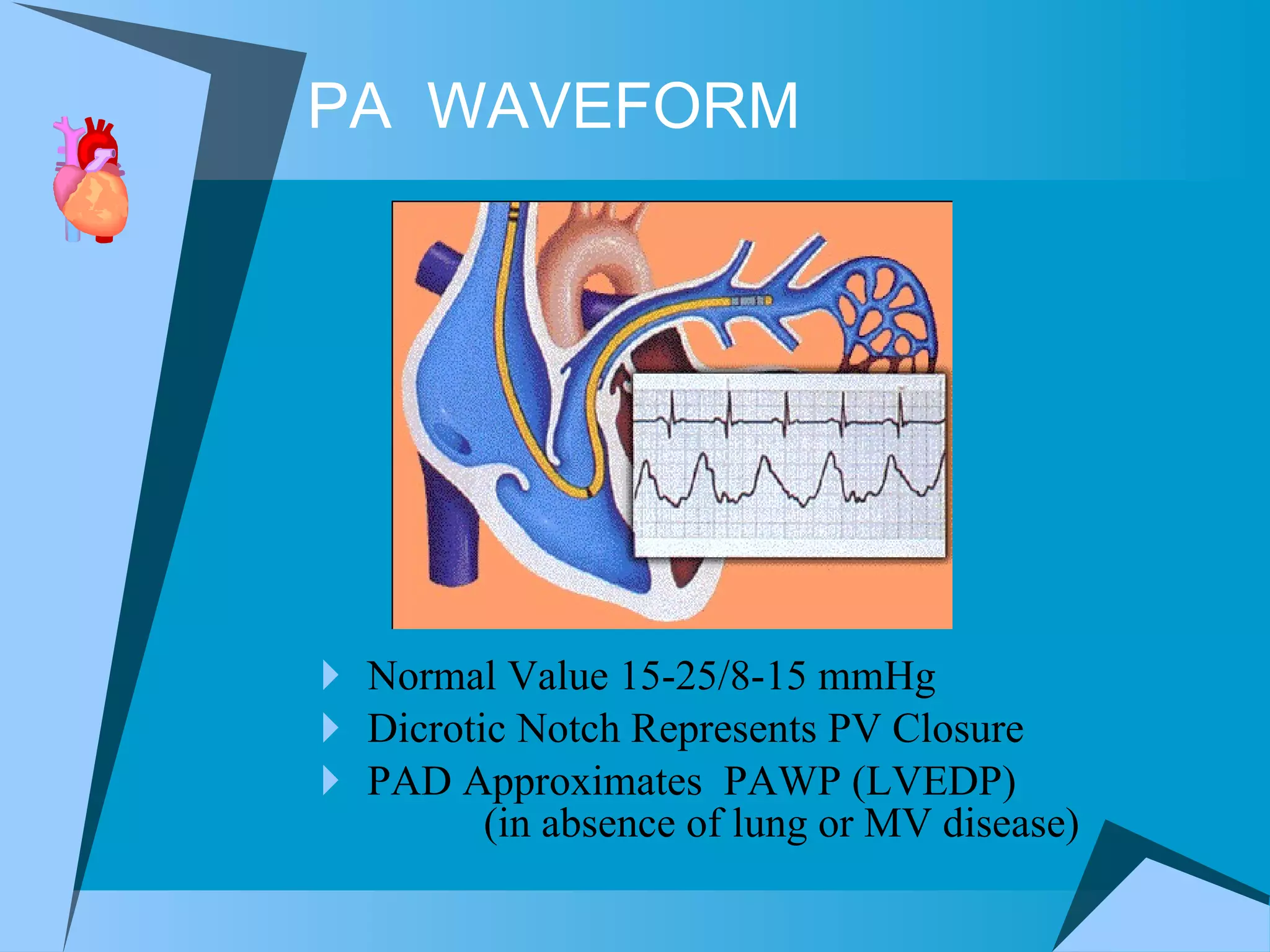 PA  WAVEFORM Normal Value 15-25/8-15 mmHg Dicrotic Notch Represents PV Closure PAD Approximates  PAWP (LVEDP)  (in absence of lung or MV disease) 