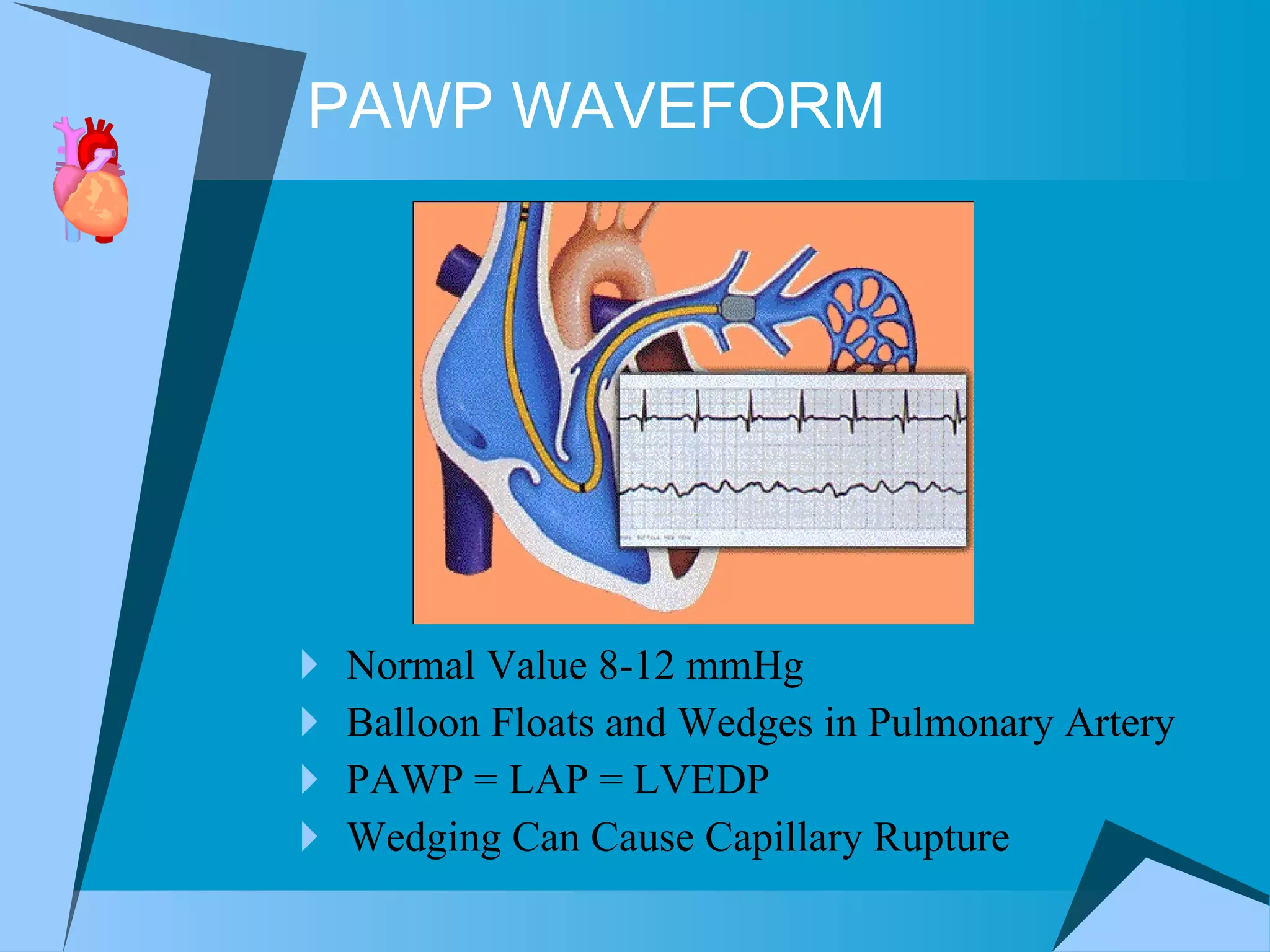 PAWP WAVEFORM Normal Value 8-12 mmHg Balloon Floats and Wedges in Pulmonary Artery  PAWP = LAP = LVEDP  Wedging Can Cause Capillary Rupture 