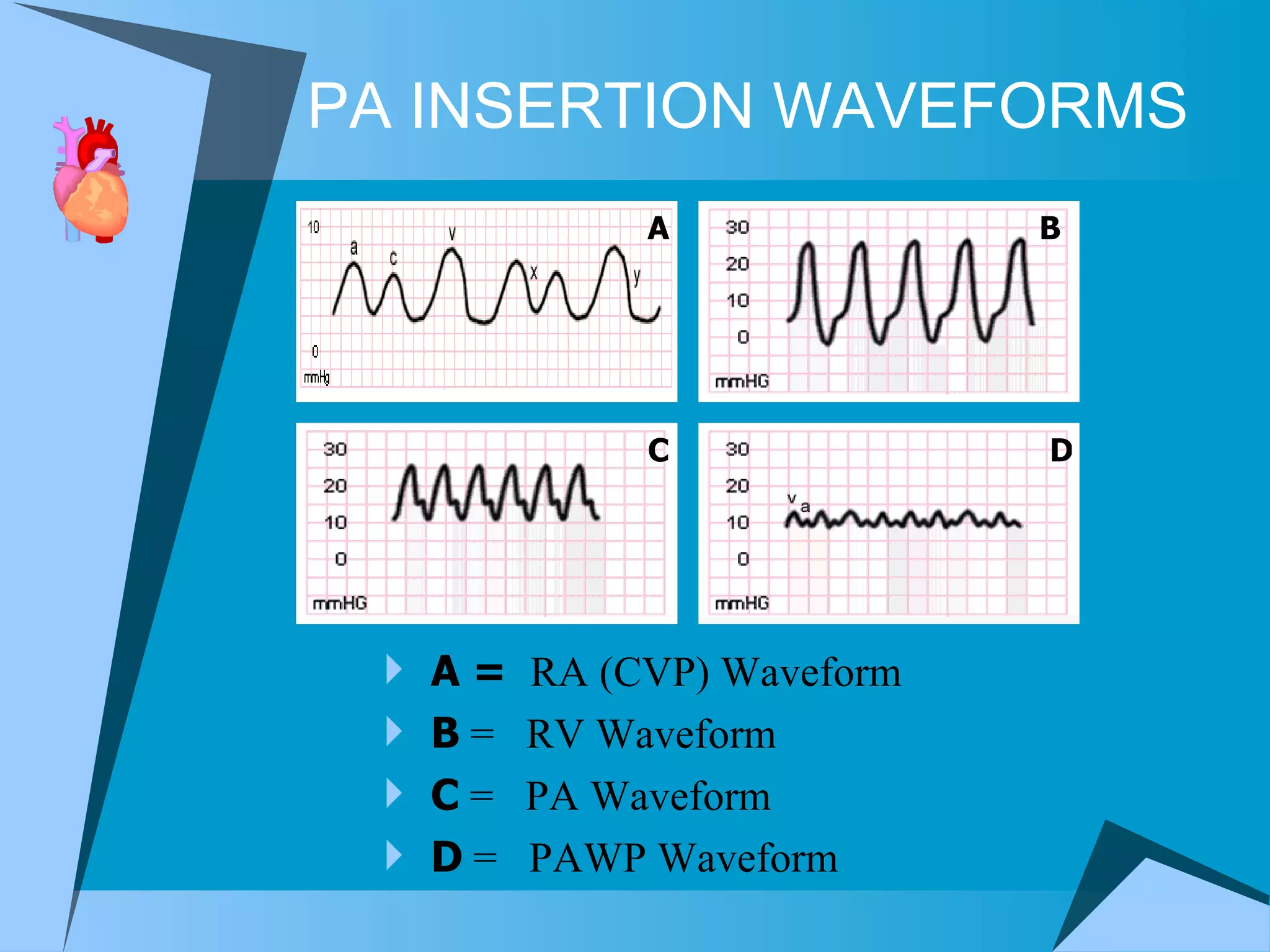 PA INSERTION WAVEFORMS A =  RA (CVP) Waveform B  =  RV Waveform C  =  PA Waveform D  =  PAWP Waveform B C D A 