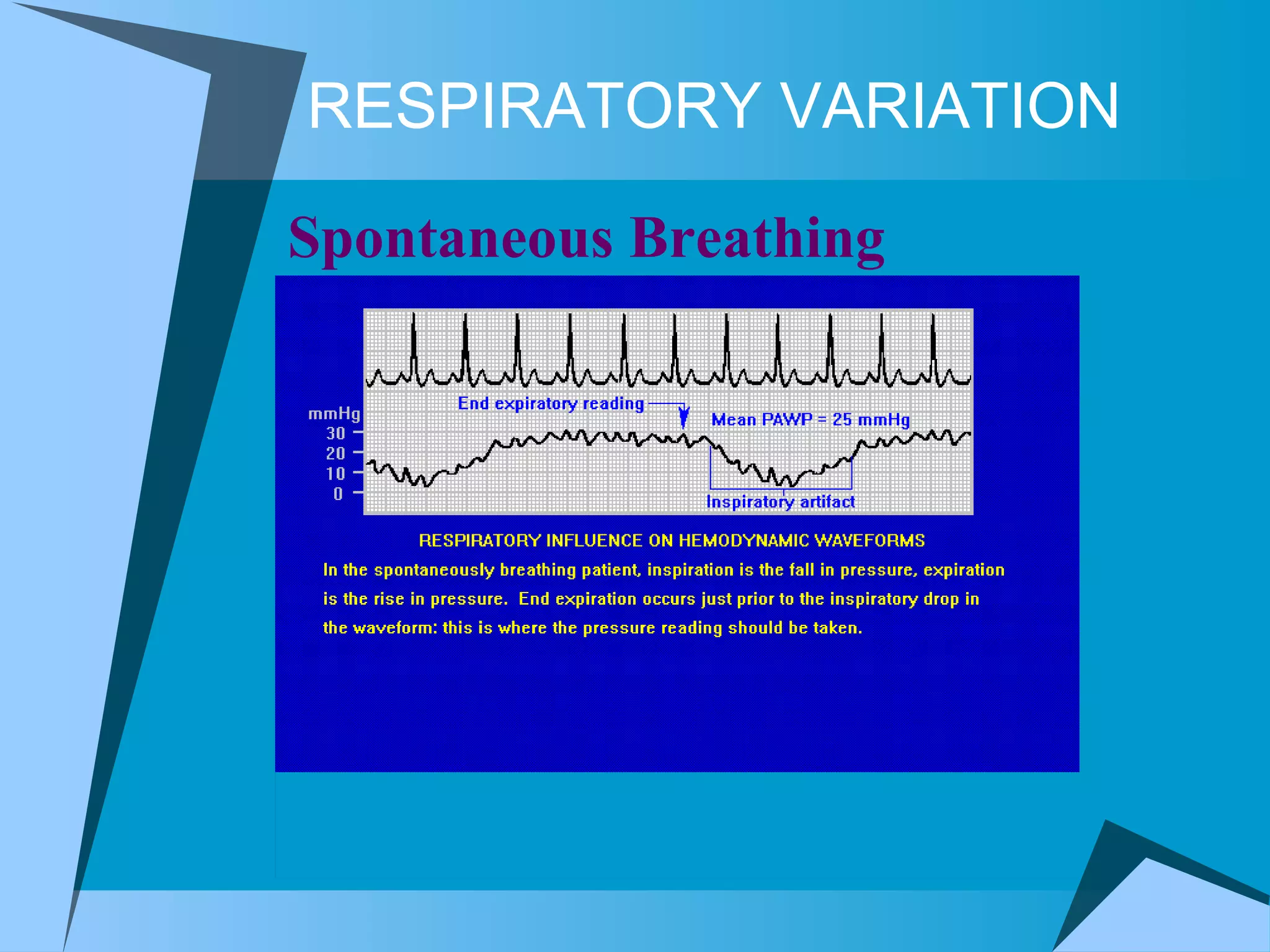 RESPIRATORY VARIATION Spontaneous Breathing 