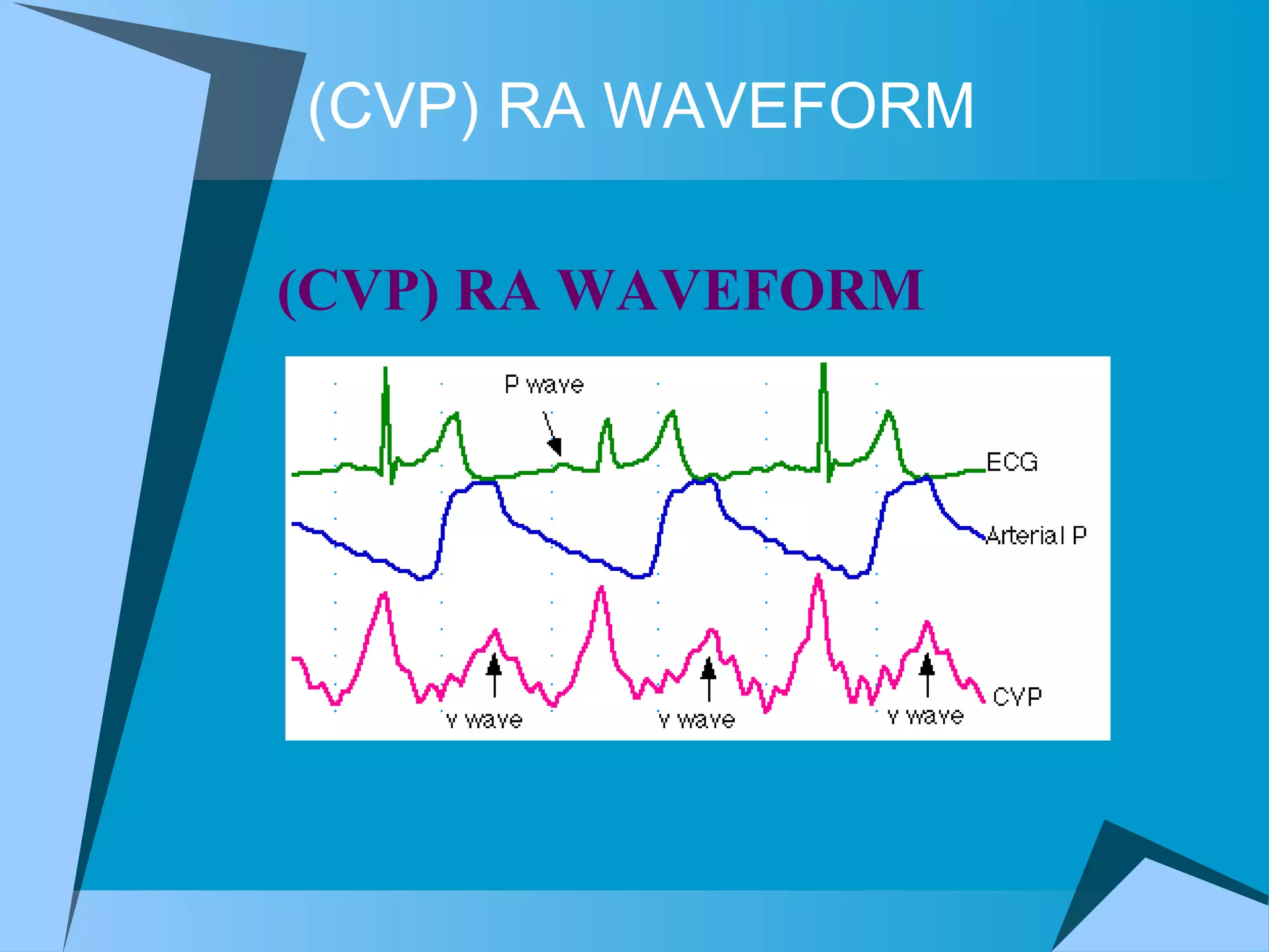 (CVP) RA WAVEFORM (CVP) RA WAVEFORM  