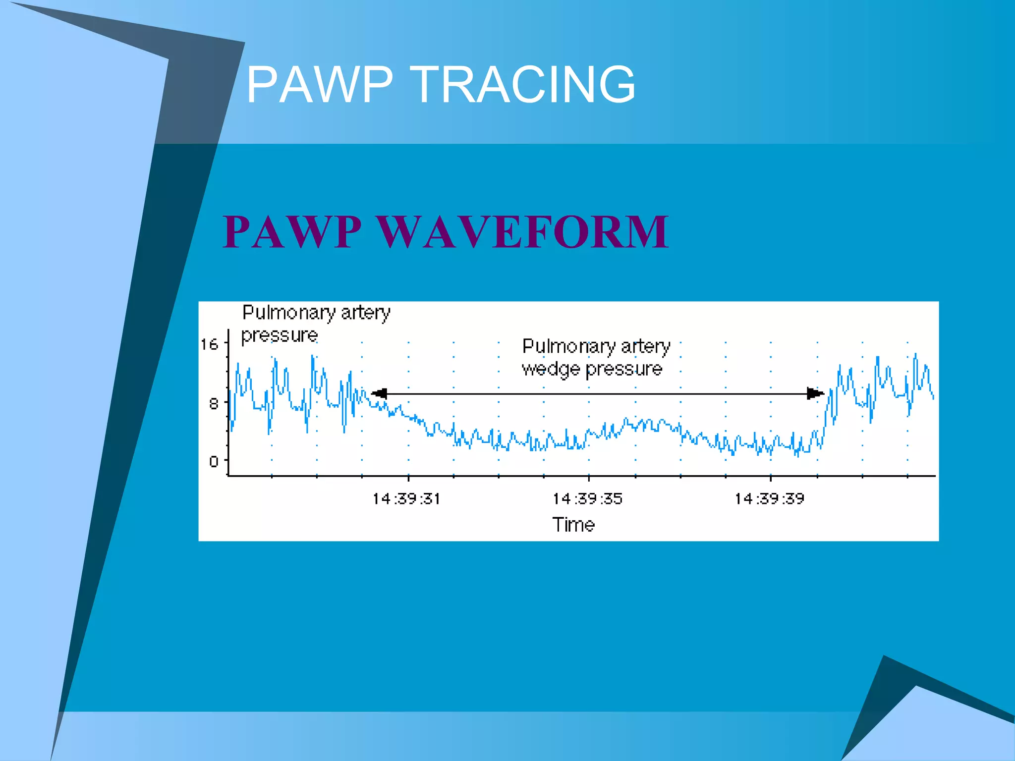 PAWP TRACING PAWP WAVEFORM  