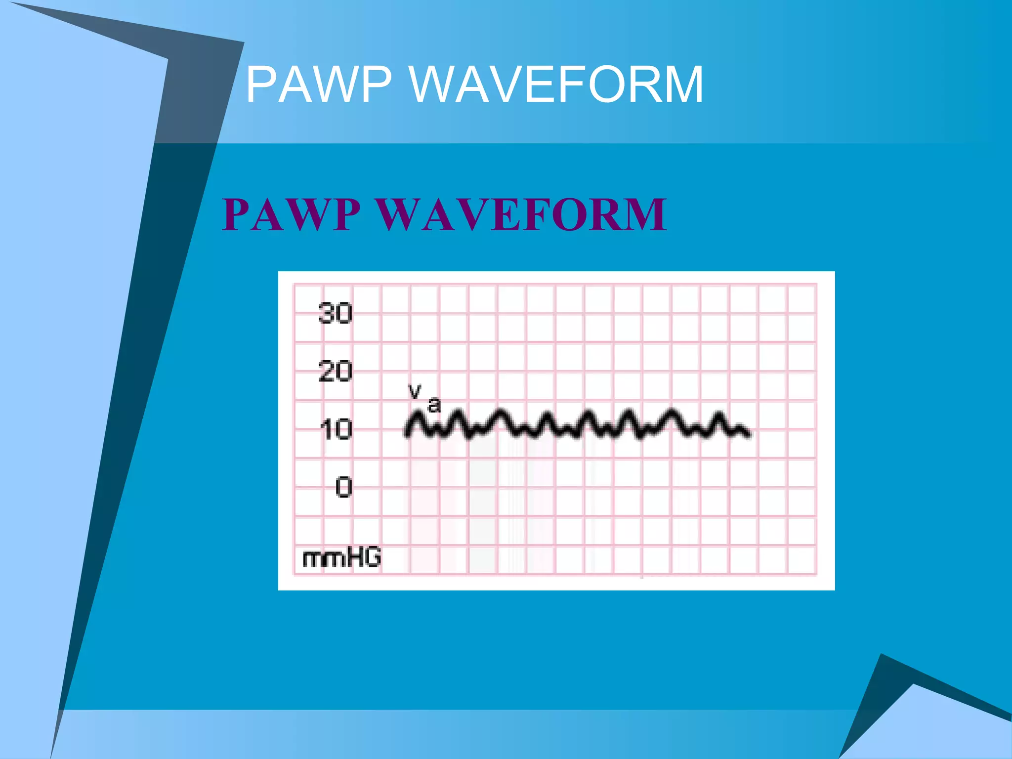 PAWP WAVEFORM PAWP WAVEFORM  