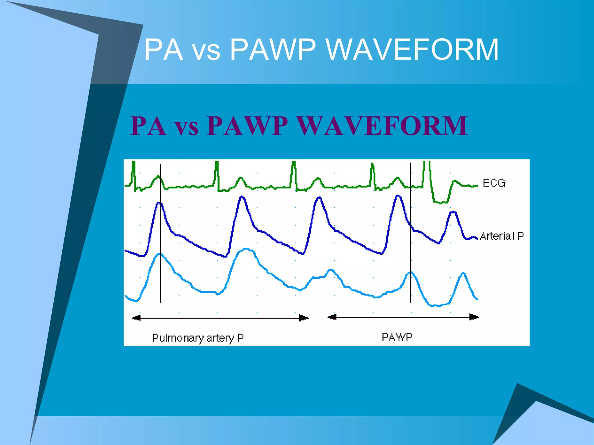 PA vs PAWP WAVEFORM PA vs PAWP WAVEFORM  