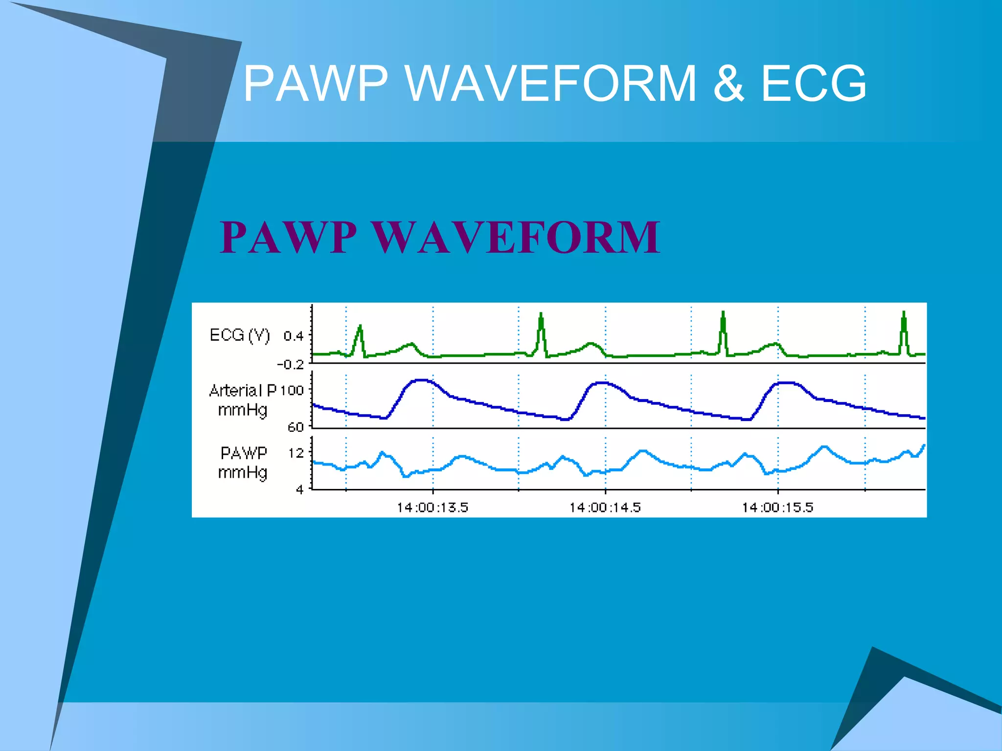 PAWP WAVEFORM & ECG PAWP WAVEFORM  