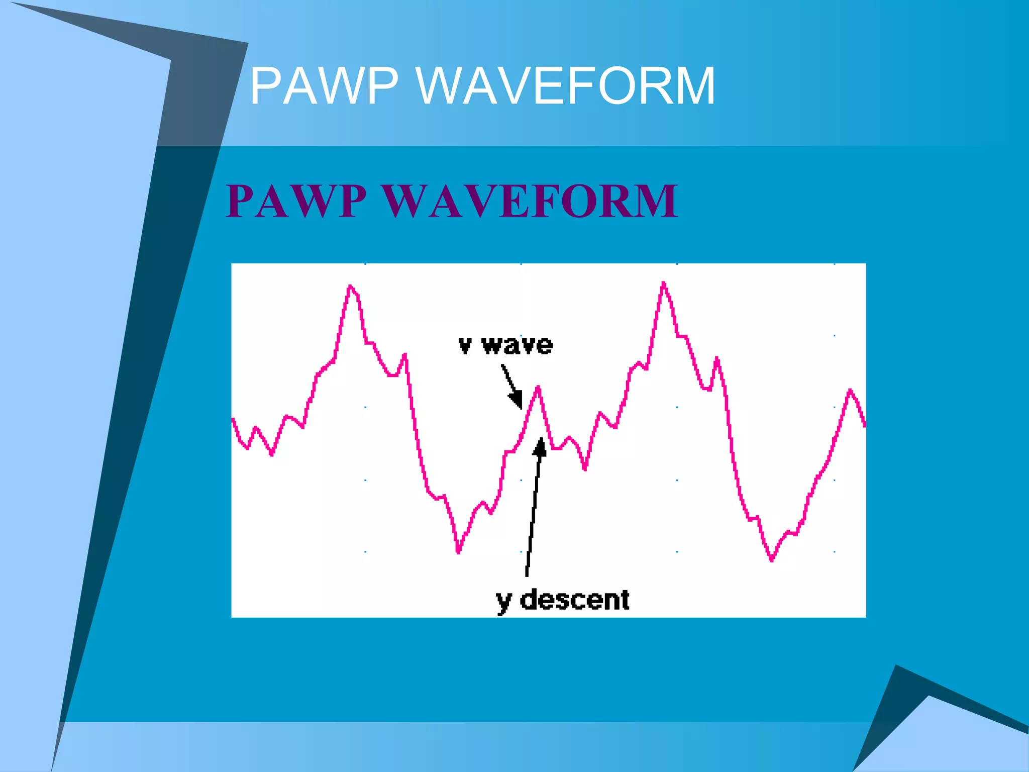 PAWP WAVEFORM PAWP WAVEFORM  