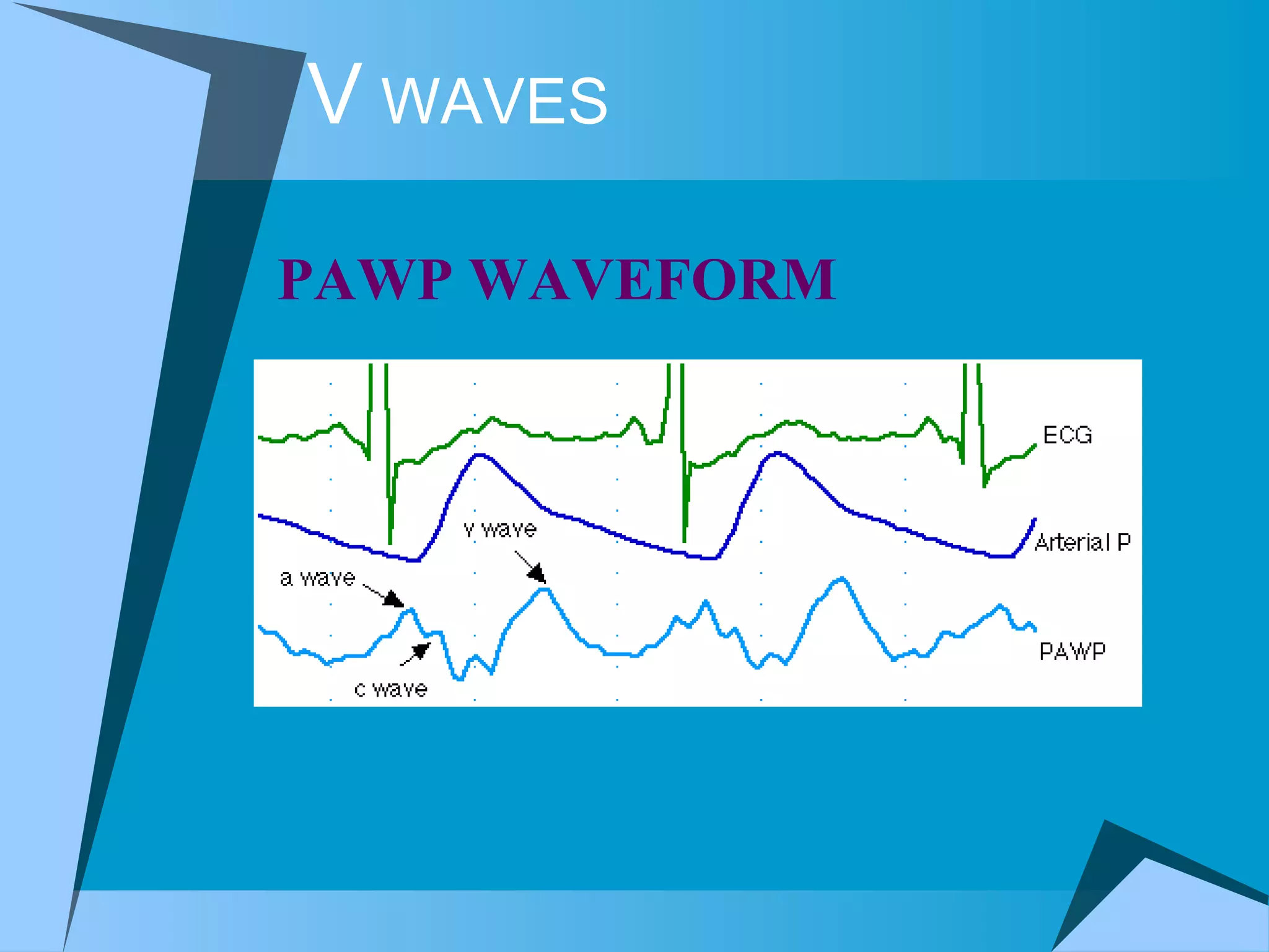 V  WAVES PAWP WAVEFORM  