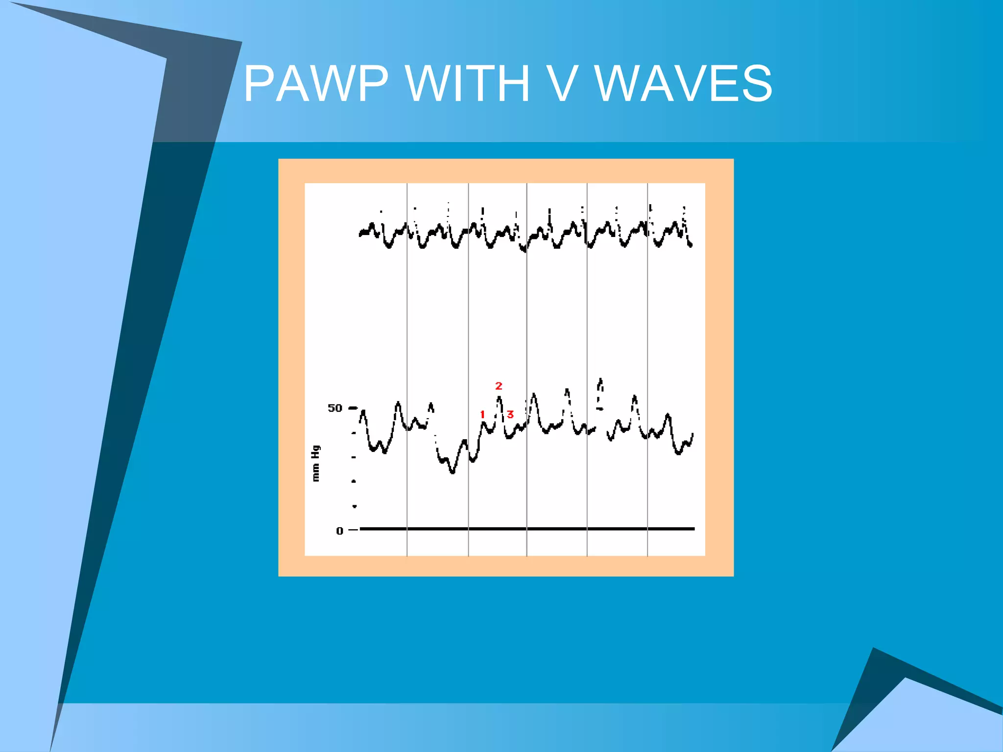 PAWP WITH V WAVES   