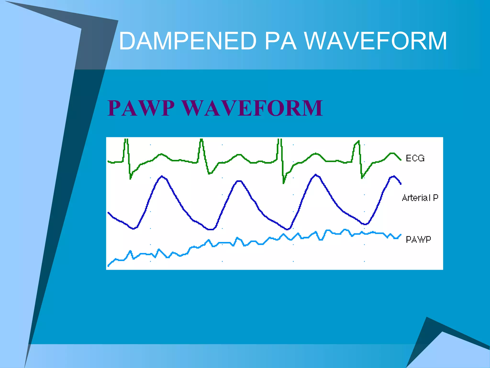 DAMPENED PA WAVEFORM PAWP WAVEFORM  