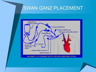 SWAN GANZ PLACEMENT  