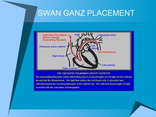 SWAN GANZ PLACEMENT  