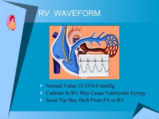 RV  WAVEFORM Normal Value 15-25/0-8 mmHg Catheter In RV May Cause Ventricular Ectopy Swan Tip May Drift From PA to RV 