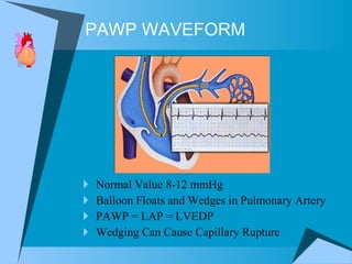 PAWP WAVEFORM Normal Value 8-12 mmHg Balloon Floats and Wedges in Pulmonary Artery  PAWP = LAP = LVEDP  Wedging Can Cause Capillary Rupture 