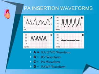 PA INSERTION WAVEFORMS A =  RA (CVP) Waveform B  =  RV Waveform C  =  PA Waveform D  =  PAWP Waveform B C D A 