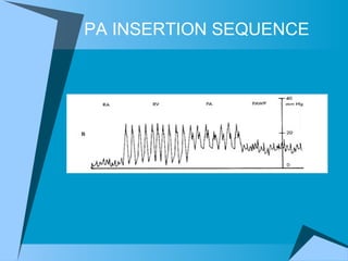 PA INSERTION SEQUENCE 