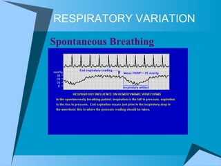 RESPIRATORY VARIATION Spontaneous Breathing 