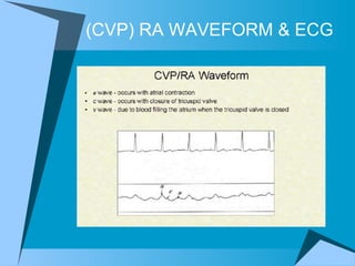 (CVP) RA WAVEFORM & ECG 