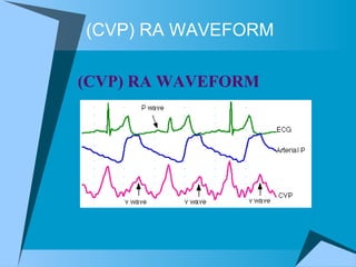 (CVP) RA WAVEFORM (CVP) RA WAVEFORM  