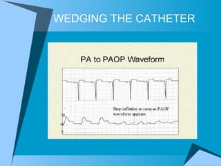 WEDGING THE CATHETER 