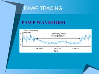 PAWP TRACING PAWP WAVEFORM  