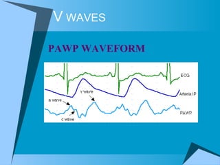 V  WAVES PAWP WAVEFORM  