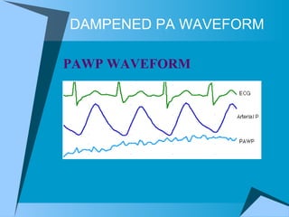 DAMPENED PA WAVEFORM PAWP WAVEFORM  
