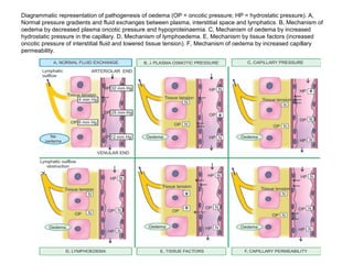 Diagrammatic representation of pathogenesis of oedema (OP = oncotic pressure; HP = hydrostatic pressure). A,
Normal pressure gradients and fluid exchanges between plasma, interstitial space and lymphatics. B, Mechanism of
oedema by decreased plasma oncotic pressure and hypoproteinaemia. C, Mechanism of oedema by increased
hydrostatic pressure in the capillary. D, Mechanism of lymphoedema. E, Mechanism by tissue factors (increased
oncotic pressure of interstitial fluid and lowered tissue tension). F, Mechanism of oedema by increased capillary
permeability.
 