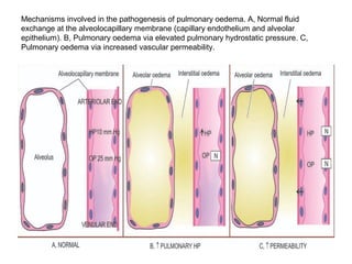 Mechanisms involved in the pathogenesis of pulmonary oedema. A, Normal fluid
exchange at the alveolocapillary membrane (capillary endothelium and alveolar
epithelium). B, Pulmonary oedema via elevated pulmonary hydrostatic pressure. C,
Pulmonary oedema via increased vascular permeability.
 