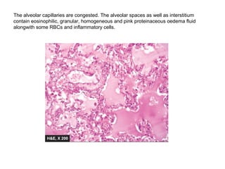 The alveolar capillaries are congested. The alveolar spaces as well as interstitium
contain eosinophilic, granular, homogeneous and pink proteinaceous oedema fluid
alongwith some RBCs and inflammatory cells.
 