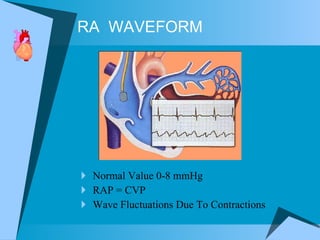 Ra Waveform Rhc Hemodynamics | PPT
