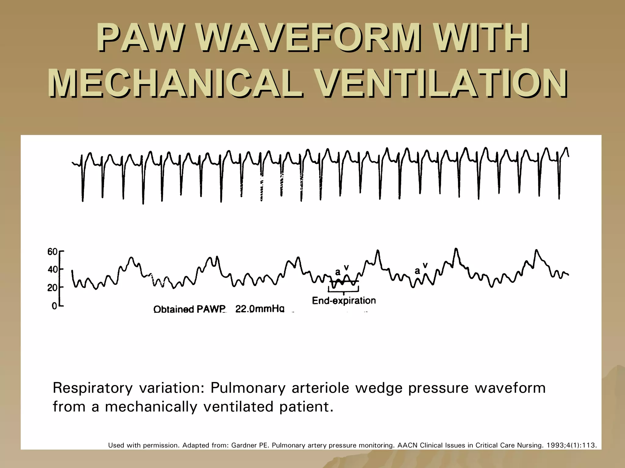 PAW WAVEFORM WITH MECHANICAL VENTILATION   