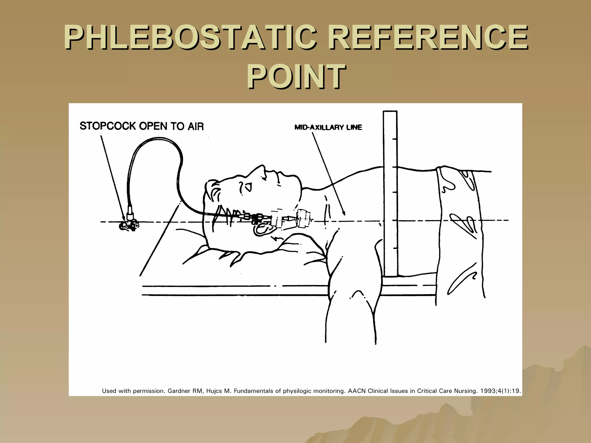 PHLEBOSTATIC REFERENCE POINT 