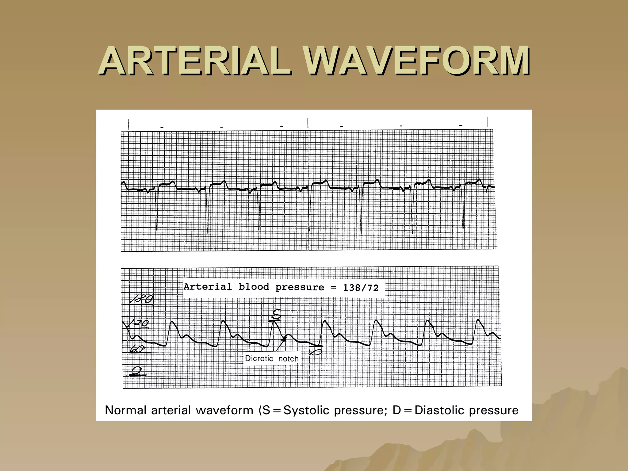 ARTERIAL WAVEFORM 