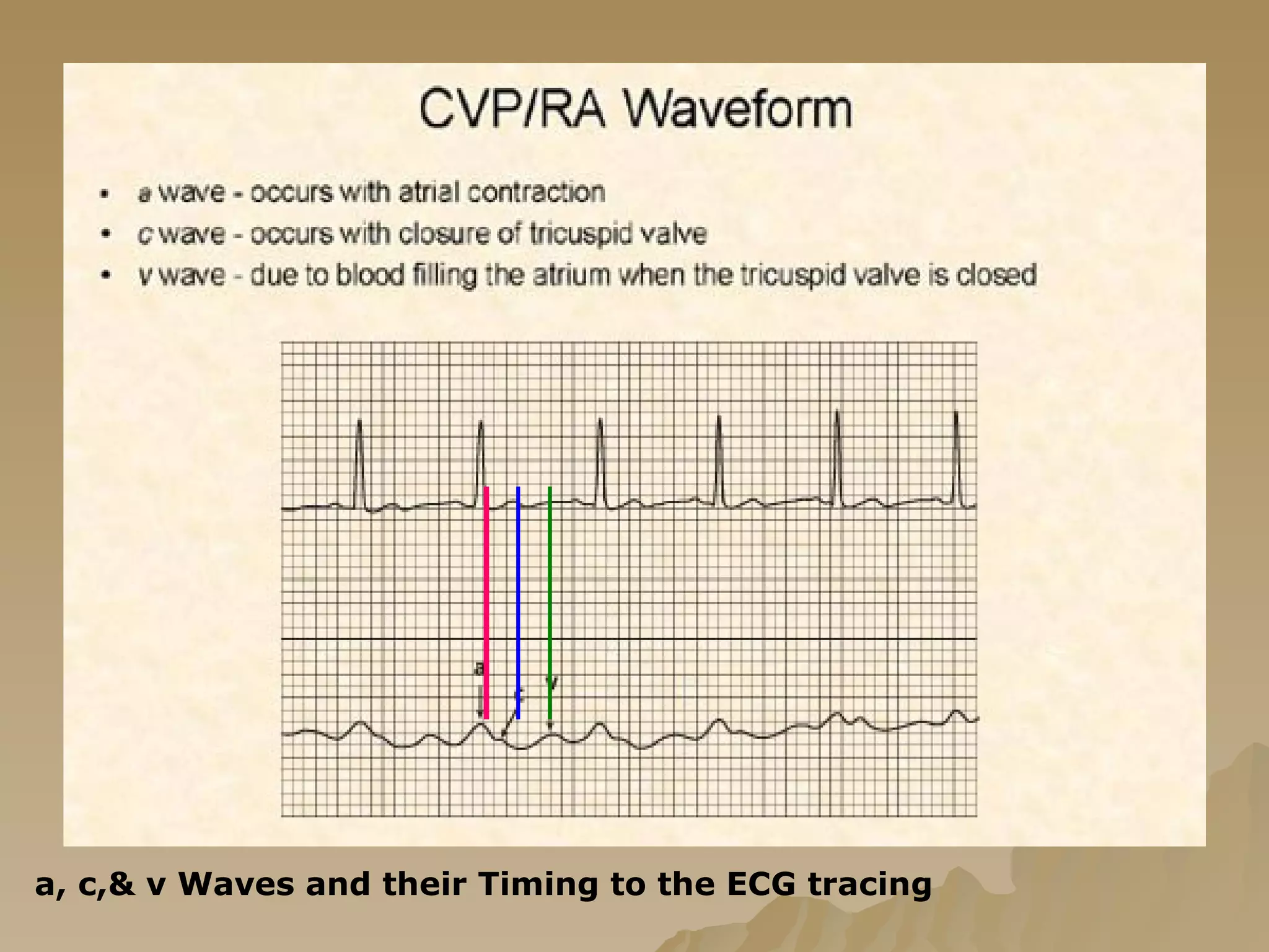 a, c,& v Waves and their Timing to the ECG tracing 
