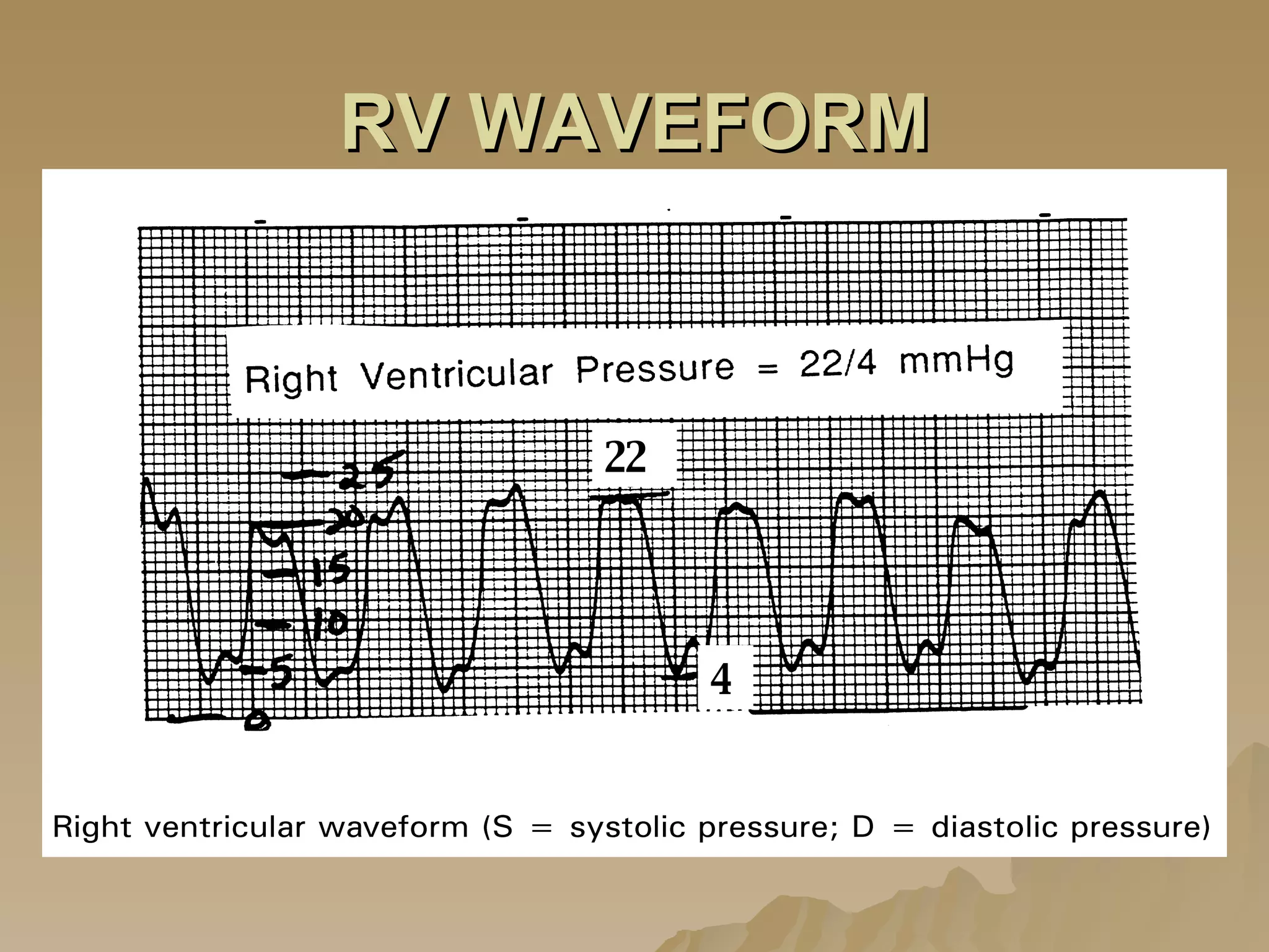 RV WAVEFORM 22 4 