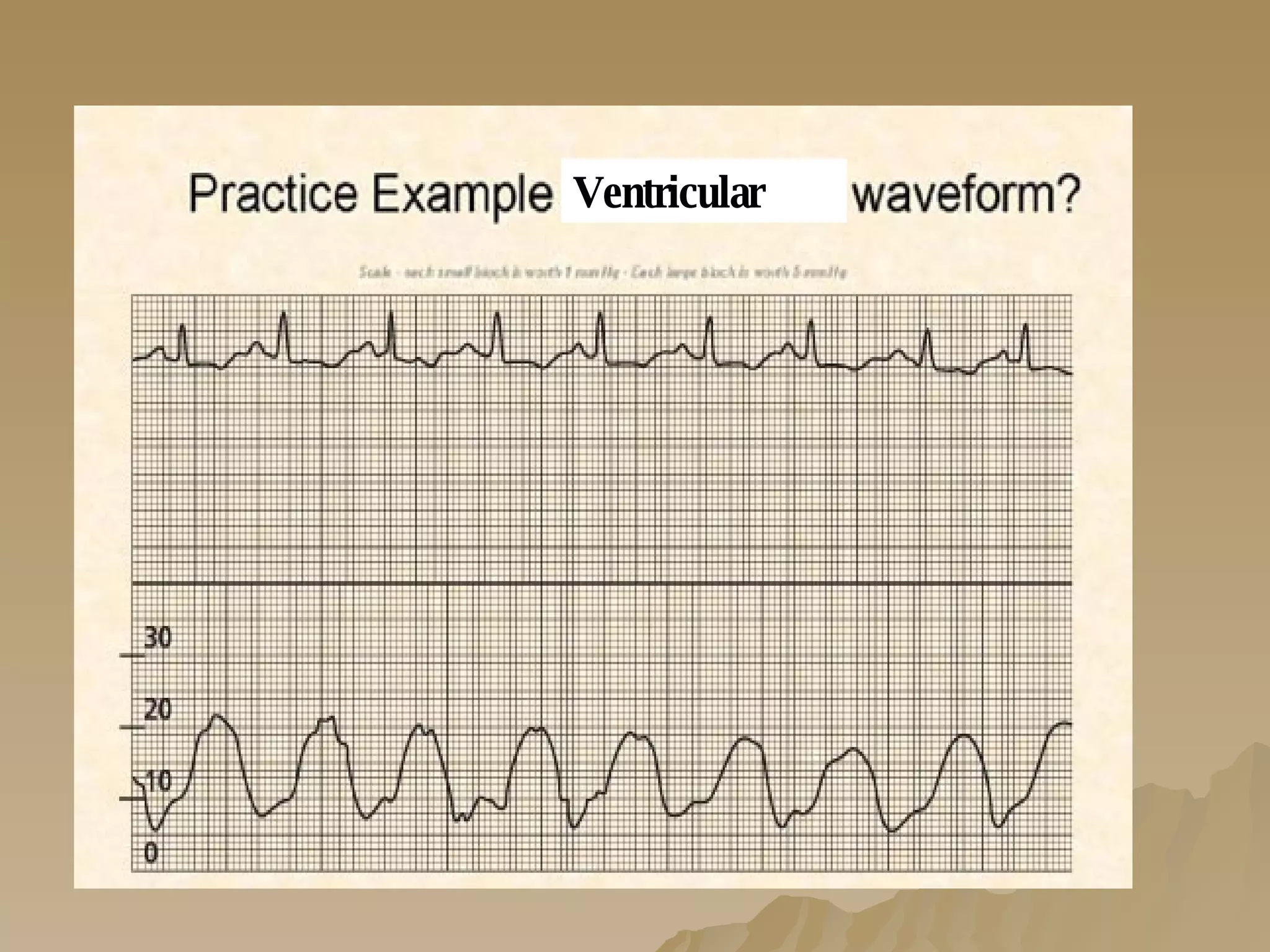 Ventricular 