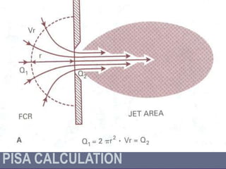 Pisa Sample Calculation Hemodynamics in echo lab by Dr. Ranjeet S.Palkar | PPTX