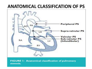 ANATOMICAL CLASSIFICATION OF PS
 