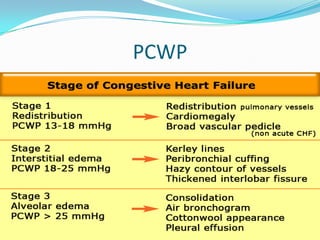 Normal Pcwp Rhc Hemodynamics presentation | PPTX