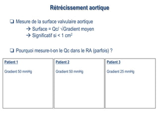 Rétrécissement aortique
❏  Mesure de la surface valvulaire aortique
à Surface = Qc/ √Gradient moyen
à Significatif si < 1 cm2
❏  Pourquoi mesure-t-on le Qc dans le RA (parfois) ?
Patient 1
Gradient 50 mmHg
Patient 2
Gradient 50 mmHg
Patient 3
Gradient 25 mmHg
 