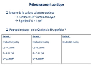Rétrécissement aortique
❏  Mesure de la surface valvulaire aortique
à Surface = Qc/ √Gradient moyen
à Significatif si < 1 cm2
❏  Pourquoi mesure-t-on le Qc dans le RA (parfois) ?
Patient 1
Gradient 50 mmHg
Qc = 4.0 l/min
S = 4.0 / √50
S = 0.60 cm2
Patient 3
Gradient 25 mmHg
Patient 2
Gradient 50 mmHg
Qc = 8.0 l/min
S = 8.0 / √50
S = 1.20 cm2
 