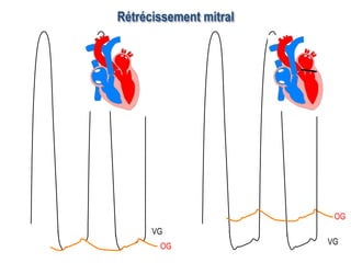 Rétrécissement mitral
OG
VG
OG
VG
 