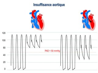 Insuffisance aortique
0
20
40
80
100
120
PAD < 50 mmHg
 
